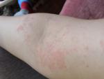 Сыпь на руке и выше фото 2