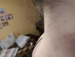 Сыпь на шее, груди и область сгиба локтей фото 2