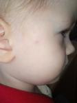 Уплотнение на щеке у ребенка фото 1