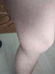 Сыпь на ногах или аллергия фото 1