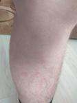 Сыпь на ногах или аллергия фото 2