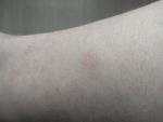 Сыпь на ногах или аллергия фото 3