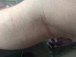 Сыпь на ногах или аллергия фото 4