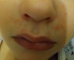 Сыпь около носа у ребёнка фото 1