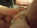 Шишка на среднем пальце ноги фото 4