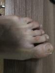 Темное пятно под ногтем на большом пальце ноги фото 1