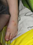 Странные пятна на ногах у ребенка фото 1