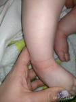 Аллергия или дерматит? Ребёнок 4 месяца фото 2