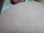 Сыпь на животе на третьем триместре беременности фото 1