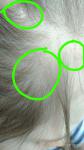 Круги на волосистой части головы фото 1