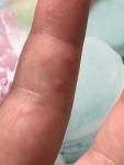 Вирус папилломы воспаление на руках, препараты для лечения фото 3