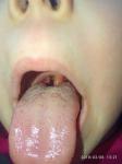 Белые тонкие полосочки в горле у ребенка фото 2