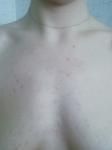 Красная сыпь на груди, без зуда фото 2