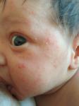 Сыпь на лице у месячного ребёнка фото 1