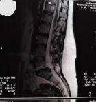 Левосторонняя медиано-парамедианная грыжа L5-S1 пояснисного отдела фото 3