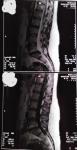Левосторонняя медиано-парамедианная грыжа L5-S1 пояснисного отдела фото 5