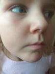 Раздражение вокруг носа у ребенка фото 1