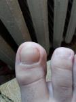 Сочится сукровица из-под ногтя без травмы и грибка! фото 1