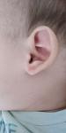 Сосудистые точки на мочке уха у ребенка фото 1