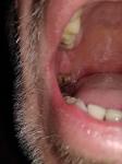 После удаления зуба образовался сгусток крови над десной фото 1