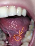 Болячка под языком белая щиплет фото 1