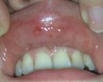 Покраснение слизистой губ фото 3