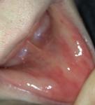 Покраснение слизистой губ фото 5