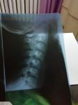Результаты рентгена шейного отдела фото 2
