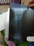 Результаты рентгена шейного отдела фото 1