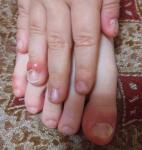 Месяц не проходят гнойные паронихии на трех пальцах у ребенка фото 4