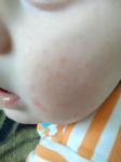 Сыпь на щеках у ребенка переходящая в красные пятна фото 1