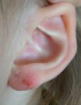 Шелушения на мочке уха фото 1