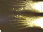 Hallux valgus фото 1