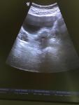 УЗИ на раннем сроке беременности, задержка 6 дней фото 1