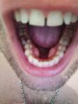 Образование на нижней челюсти с внутренней стороны зубов фото 1