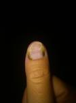 Болезнь ногтя фото 1