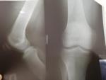 Травма или артроз коленного сустава? фото 1