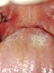 Болит горло и пупырышки на корне языка фото 2