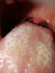 Болит горло и пупырышки на корне языка фото 1