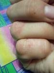 Трескается кожа на пальцах рук, пораженные участки увеличиваются фото 4