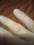 Трескается кожа на пальцах рук, пораженные участки увеличиваются фото 1