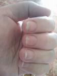 Грибок ногтей на руках после наращивания фото 2