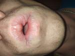 Сыпь на верхней губе в виде пузырьков фото 1