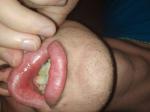 Сыпь на верхней губе в виде пузырьков фото 3