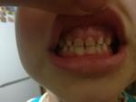 Полоски на зубах фото 1