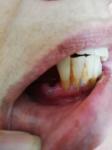 Белое пятно на десне после удаление зуба фото 1