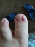 Панацирий воспаление около ногтей большого пальца ноги как лечить фото 2