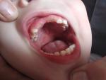 Язвочки во рту у ребёнка 3 лет фото 1