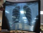 Вопрос по Расфифровке рентгена лёгких фото 1
