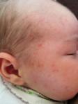 Акне новорожденных или аллергия фото 1